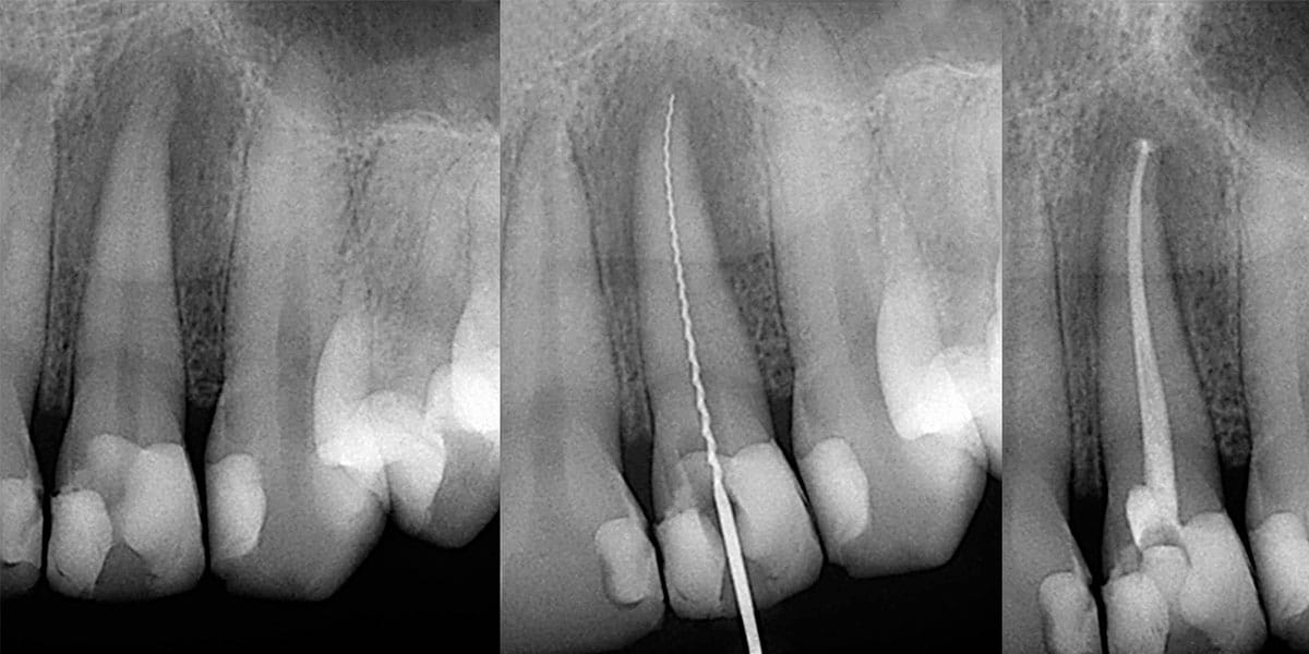 Endodontics (Root Canal Therapy)
